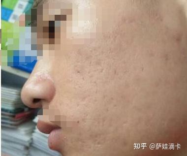 科技进展下的祛疣新方法探讨与研究