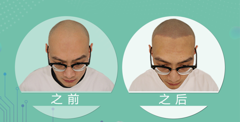 最新脱发技术重塑自信与美丽风采