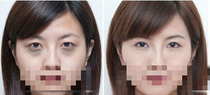 激光去黑眼圈价格表详解，深度分析与观点阐述